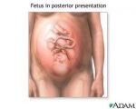 Posterior Position