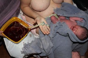Knot in umbilical cord